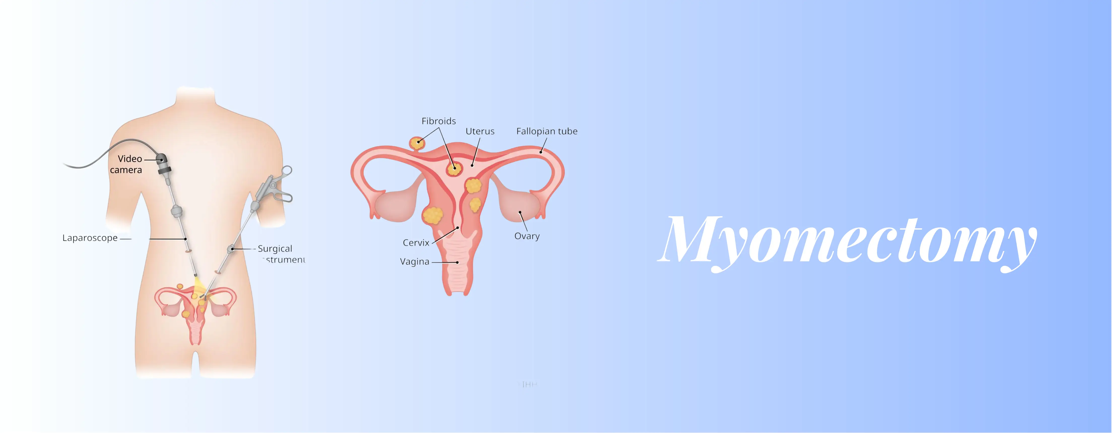 Myomectomy Surgery Cost In Delhi | Get Price Estimate