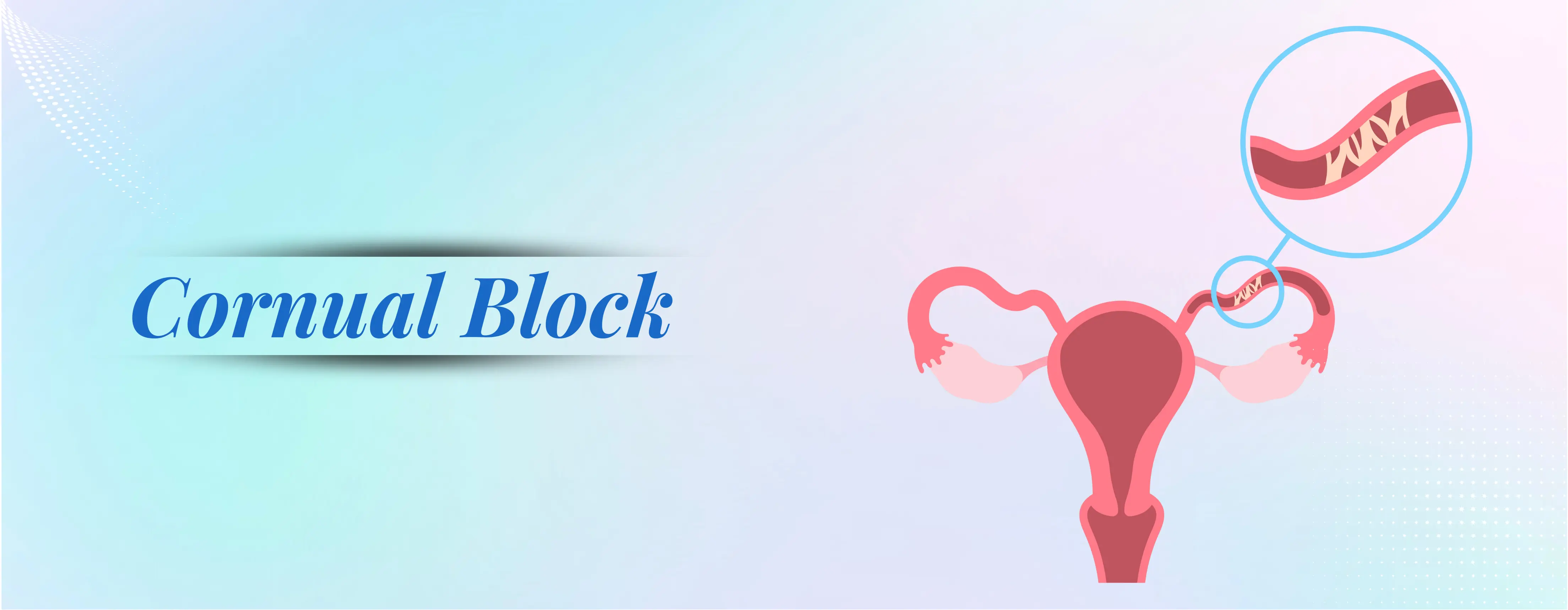 Cornual Block In Fallopian Tubes Surgery In Delhi | SNH