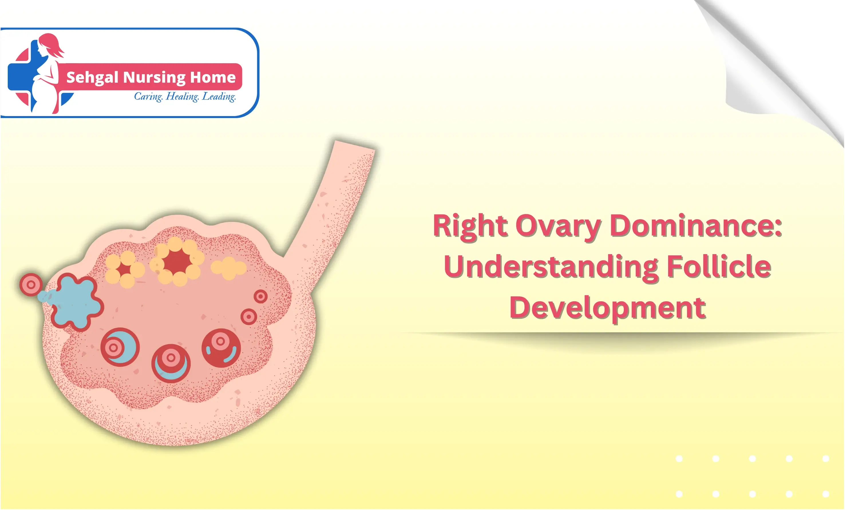 Right Ovary Dominance: Understanding Follicle Development